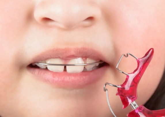 Czy można czyścić ruchomy aparat ortodontyczny pastą do zębów?