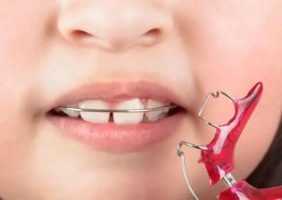 Jak dbać o ruchomy aparat ortodontyczny w podróży?